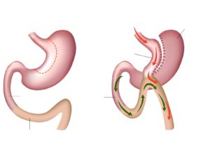 Mini-Gastric-Bypass