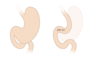 gastric sleeve