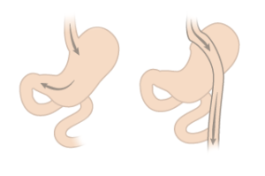 maost möödajuhtiv operatsioon gastric bypass